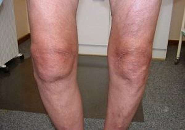 Виды и лечение контрактуры колена